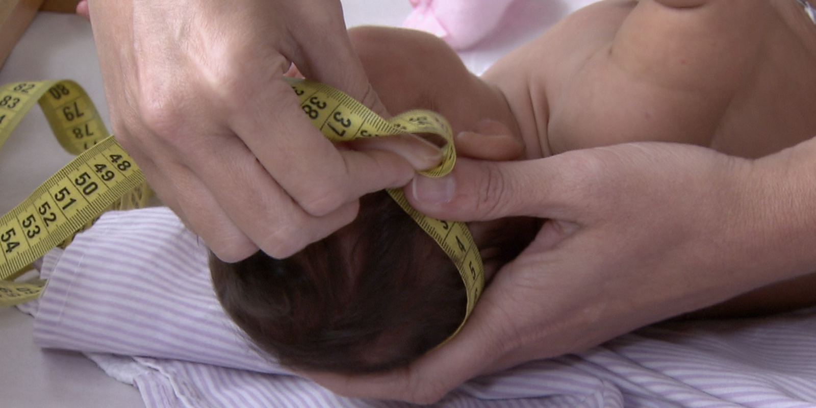 bebe_com_microcefalia