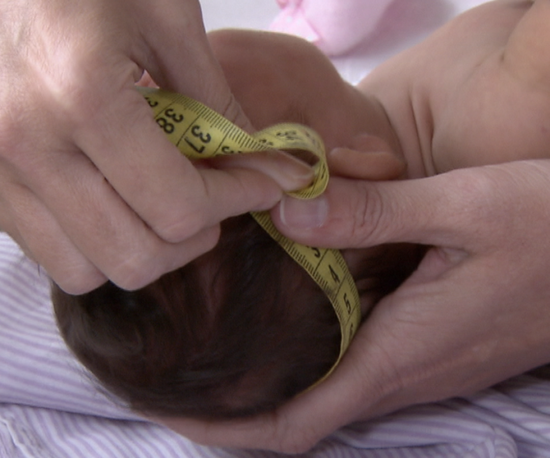bebe_com_microcefalia