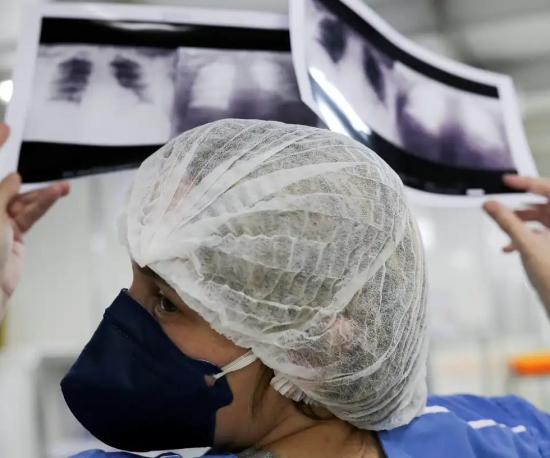 radiografia_de_torax_coronaviruscovid-19_hospital_sao_paulo1205200325