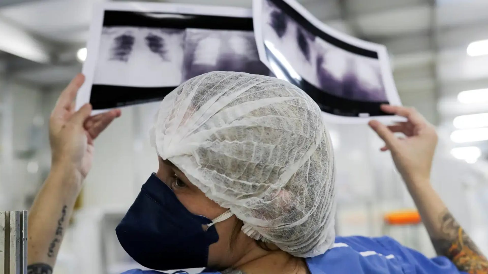 radiografia_de_torax_coronaviruscovid-19_hospital_sao_paulo1205200325